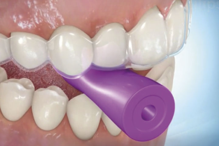 indicaciones-mordedores mordedores con invisalign