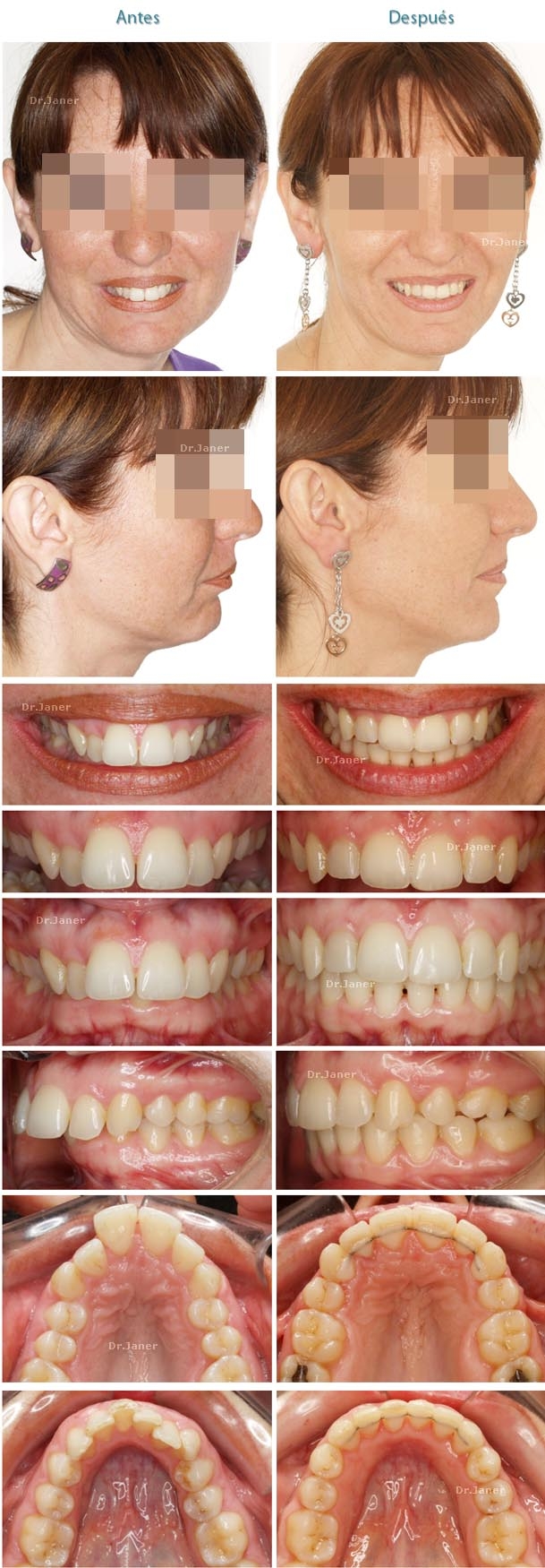 th_fd0b9a1c7f8985b1ea08ff5f1094917c_casoapiñamientoresaltemarcadoextraccionesdentalesdamonjanerortodoncia