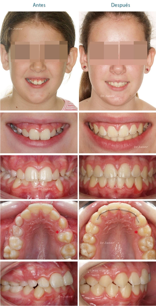 th_fd0b9a1c7f8985b1ea08ff5f1094917c_casopaladarestrechoapinamientoyextracciondental_web