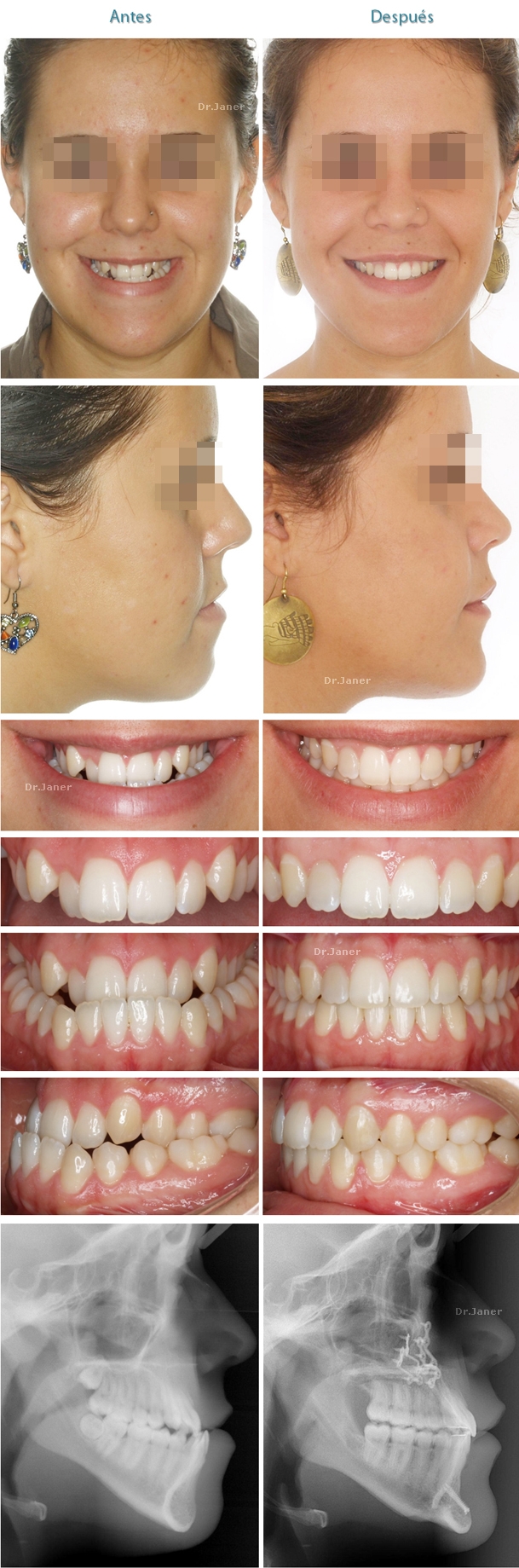 th_fd0b9a1c7f8985b1ea08ff5f1094917c_prognatismomandibular