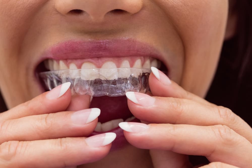 Cambios que podrás observar en tus dientes durante el tratamiento de ortodoncia invisible