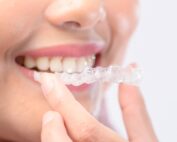 Como funciona la ortodoncia invisible